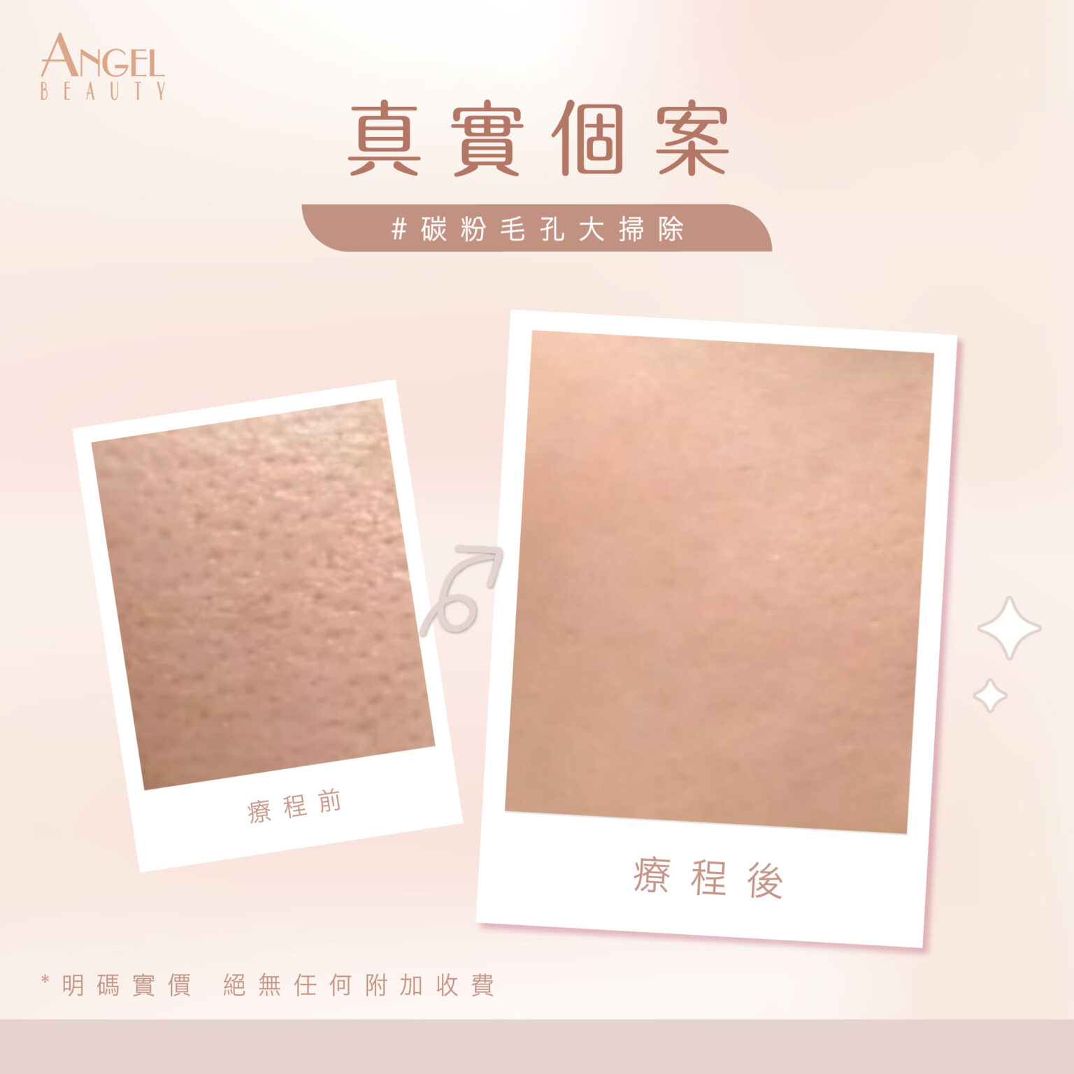 脫疣 淡斑 黑色 嫩膚 毛孔粗大 暗粒 面部瑕疵 粉刺 angel beauty